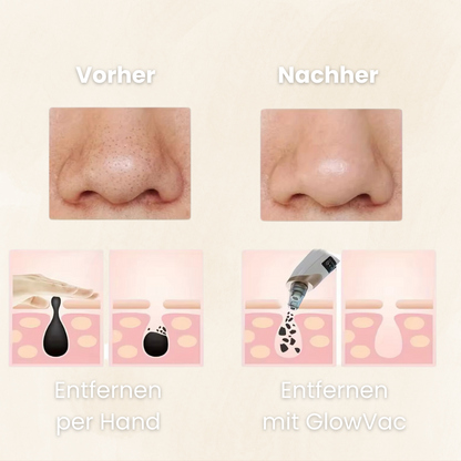GlowVac - Verabschiede dich von Mitessern